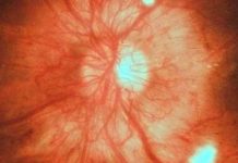 Acute Macular Neuroretinopathy (AMN) in Young Healthy Patients During the COVID-19 Pandemic