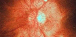 Acute Macular Neuroretinopathy (AMN) in Young Healthy Patients During the COVID-19 Pandemic