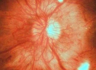 Acute Macular Neuroretinopathy (AMN) in Young Healthy Patients During the COVID-19 Pandemic