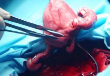 Advancements in Uterine Transplantation: A Quarter Century of Preclinical Research and Clinical Milestones