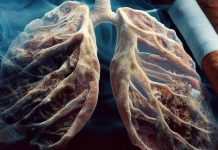 Importance of Studying Tobacco-Exposed Individuals with Preserved Spirometry and Respiratory Symptoms