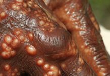 Leprosy in Central Florida: An Emerging Endemic Disease with Mysterious Transmission Routes