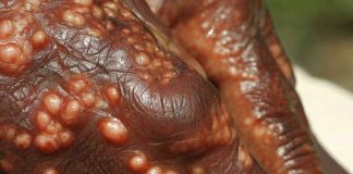 Leprosy in Central Florida: An Emerging Endemic Disease with Mysterious Transmission Routes