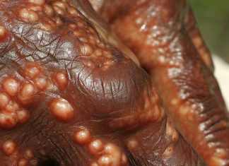 Leprosy in Central Florida: An Emerging Endemic Disease with Mysterious Transmission Routes