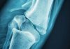 Oral Corticosteroid Prescribing Patterns and Fracture Preventive Care