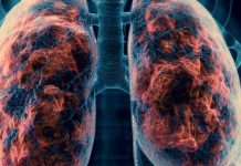 Rituximab and Cancer Chemotherapeutic Drugs: Implications for Post-COVID-19 Pulmonary Fibrosis Risk – A Nationwide Cohort Study