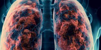 Rituximab and Cancer Chemotherapeutic Drugs: Implications for Post-COVID-19 Pulmonary Fibrosis Risk – A Nationwide Cohort Study