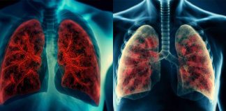 Exploring the Interplay of Vitamin D, Tuberculosis, and COVID-19 Severity in Mongolia