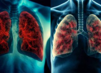 Exploring the Interplay of Vitamin D, Tuberculosis, and COVID-19 Severity in Mongolia