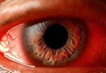 Exploring the Link Between Calcium Channel Blockers and Glaucoma: Findings from a UK Biobank Study