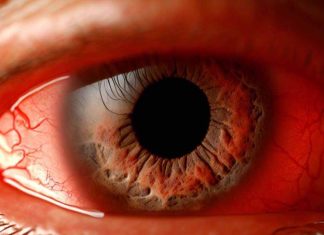Exploring the Link Between Calcium Channel Blockers and Glaucoma: Findings from a UK Biobank Study