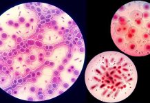 Alarming Surge in Sexually Transmitted Infections Demands Global Attention