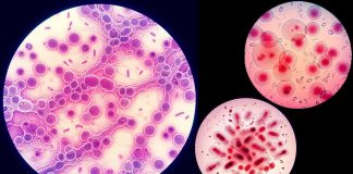 Alarming Surge in Sexually Transmitted Infections Demands Global Attention